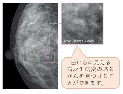 微細石灰化の集簇|マンモグラフィ検査で見られる石灰化病変について